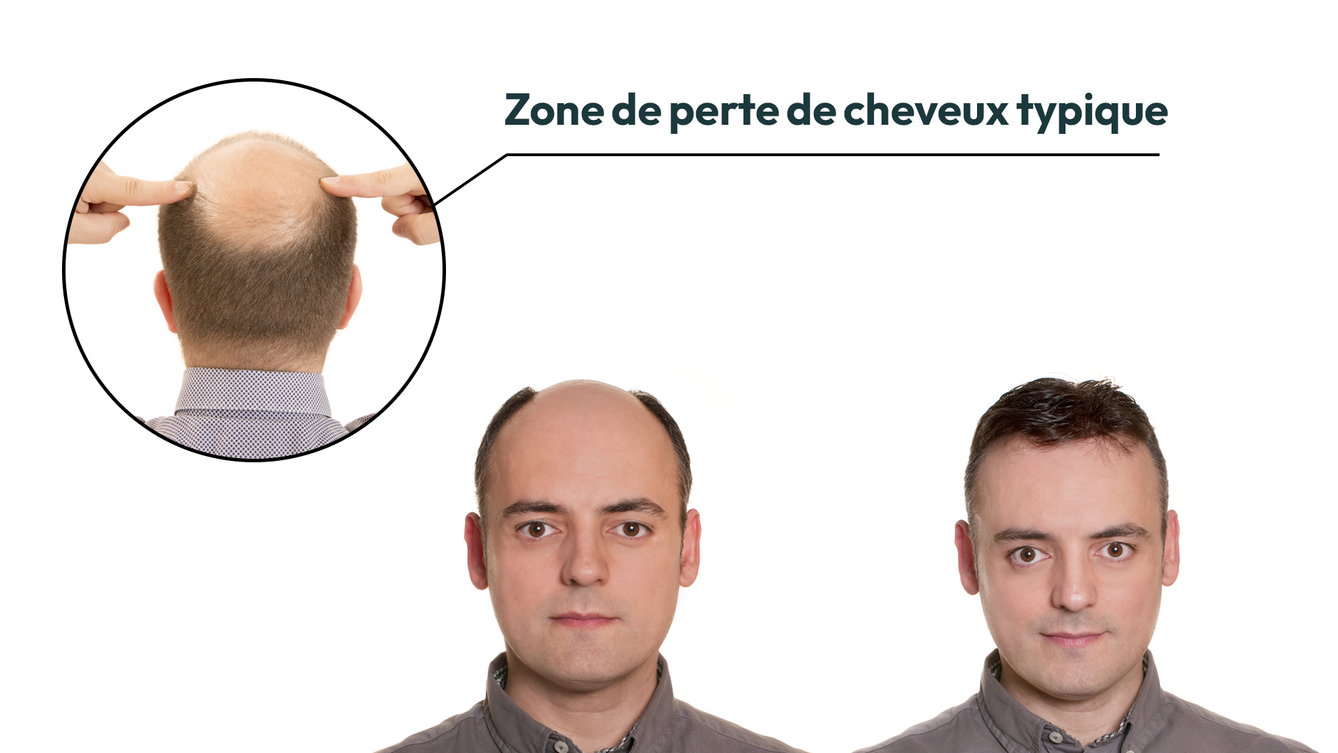 La perte des cheveux