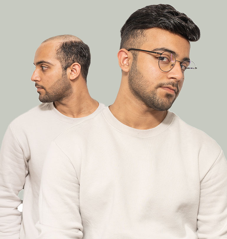 Complément Capillaire Pour Hommes